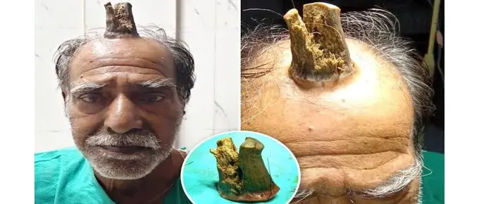 आदमी के सिर पर निकला जानवरों जैसा सींग
